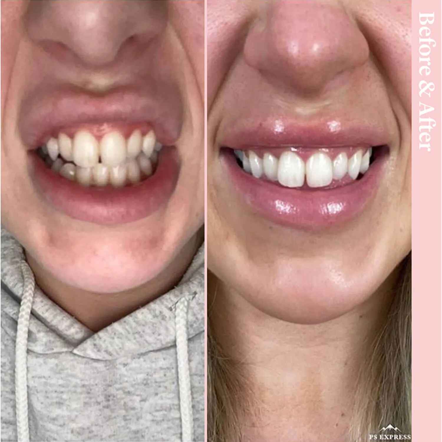 Oral Care Mouthwash for Decay 500ml